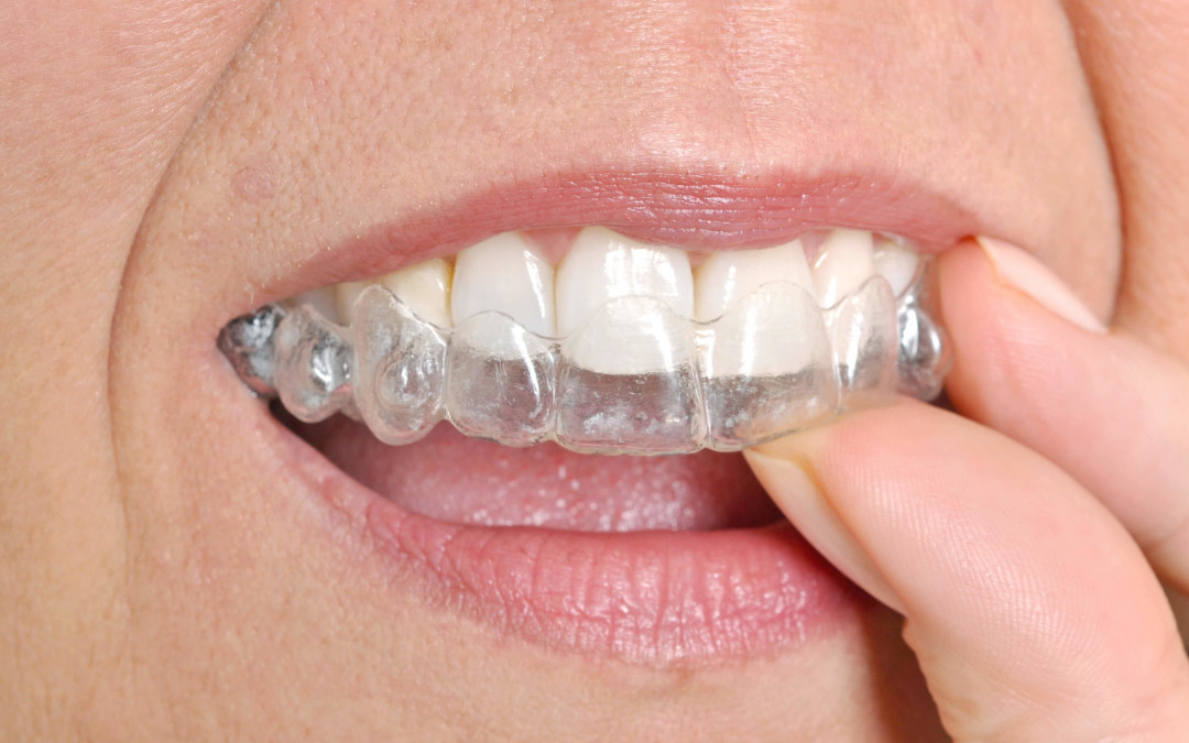 Get Invisalign in west hills by a certified orthodontist