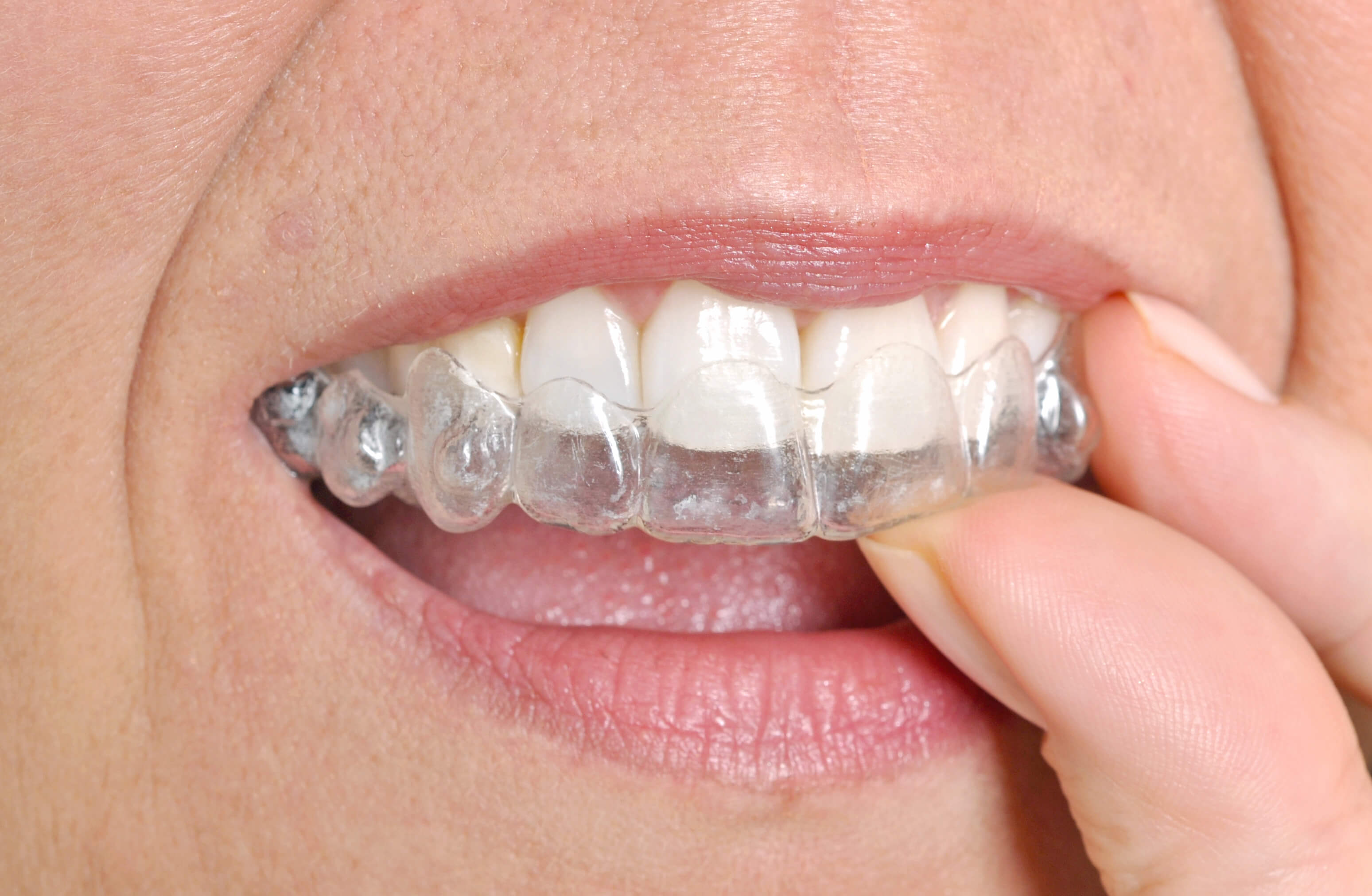 Get Invisalign in west hills by a certified orthodontist